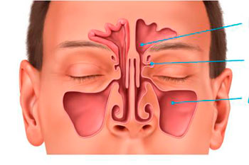 What is Sinusitis?